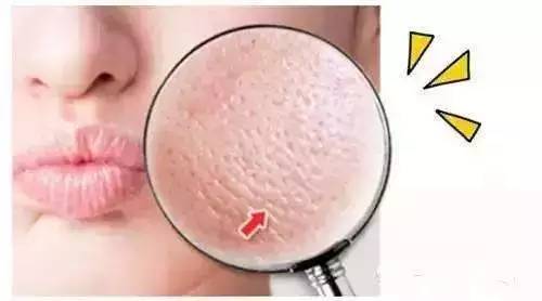 过盛的油脂导致毛孔粗大