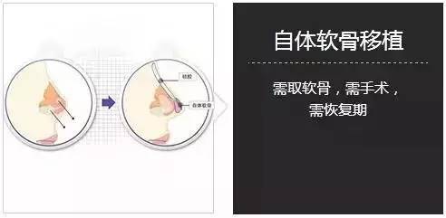 上海美莱自体软骨隆鼻