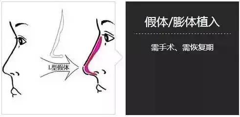 上海美莱陈斌为你介绍隆鼻整形的三大方法