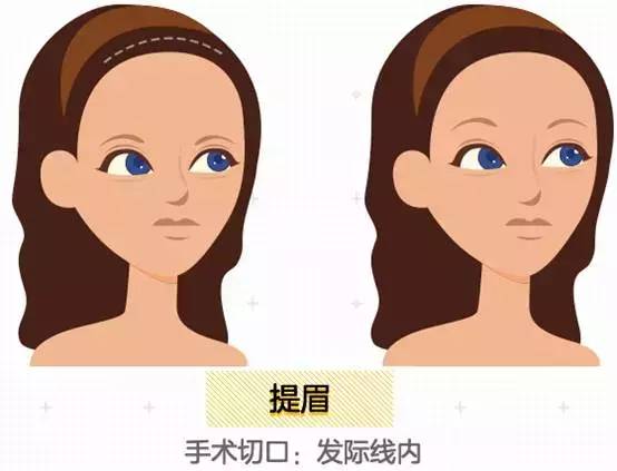 上海美莱提眉手术