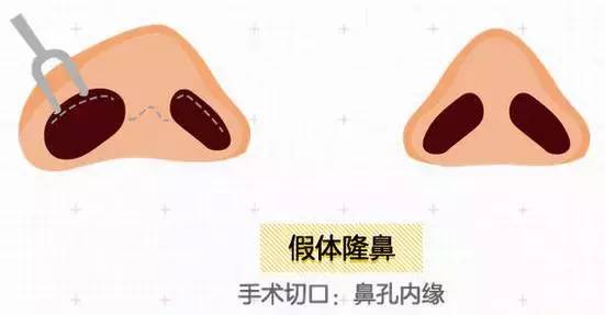 上海美莱隆鼻整形
