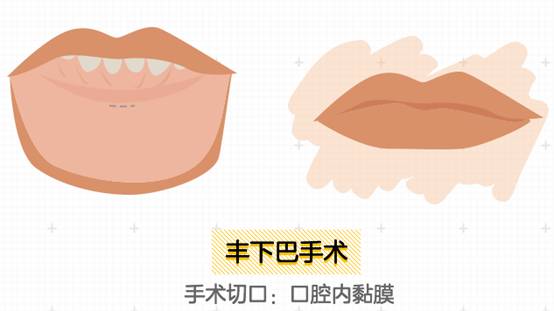 美莱丰下巴手术