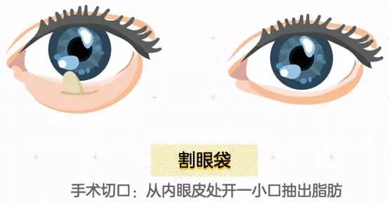 上海美莱去眼袋手术