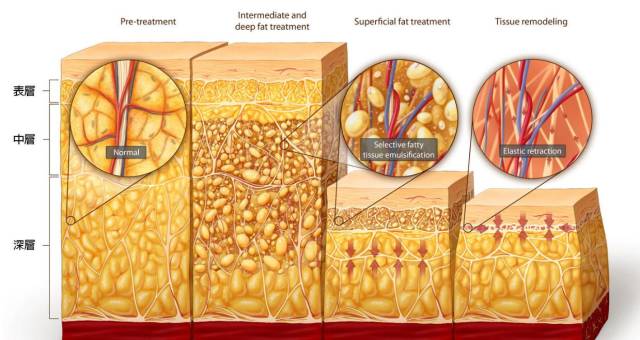 多维立体吸脂减肥安全