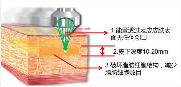上海美莱美容整形医院聚焦超声吸脂原理