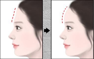 上海美莱玻尿酸注射丰额头