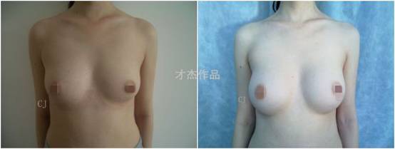 才杰丰胸整形手术案例