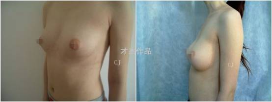 才杰丰胸整形案例