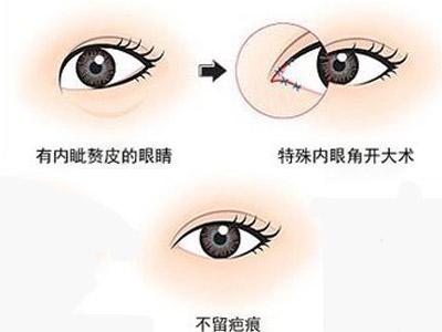 上海美莱开眼角整形手术价格