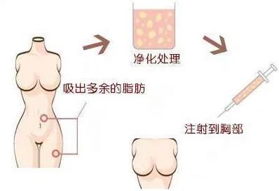上海美莱自体脂肪过程
