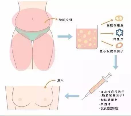 自体脂肪丰胸过程