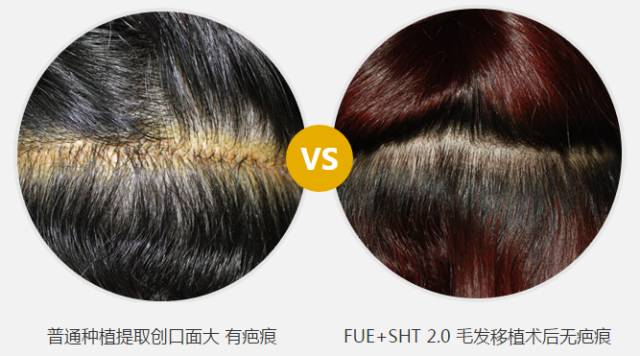 上海美莱连锁植发院长袁玉坤教授亲自操作