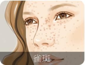 上海美莱激光去除雀斑