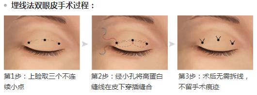 上海整形美容美莱双眼皮埋线