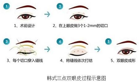 上海整形美容美莱韩式三点双眼皮