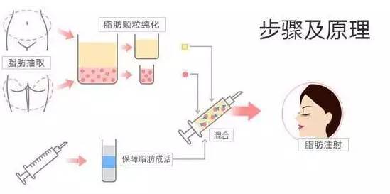 上海整形美莱自体脂肪丰苹果肌过程