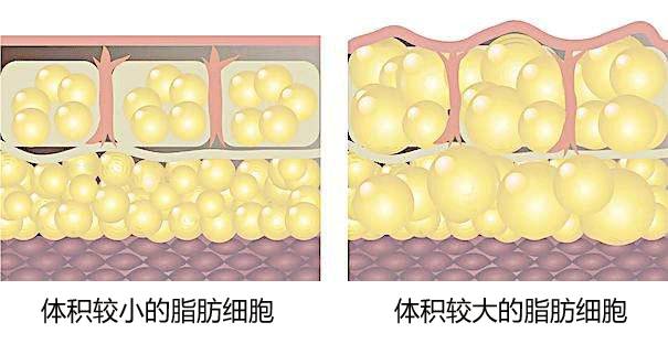 美莱吸脂不反弹