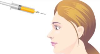 注射去除额头纹