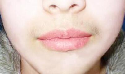 上海美莱激光脱毛