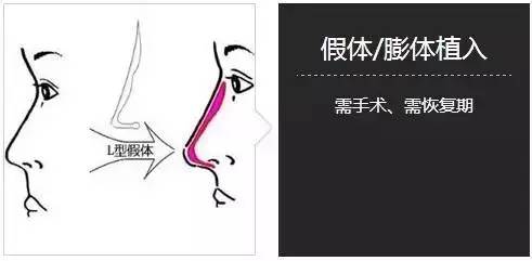 假体隆鼻整形