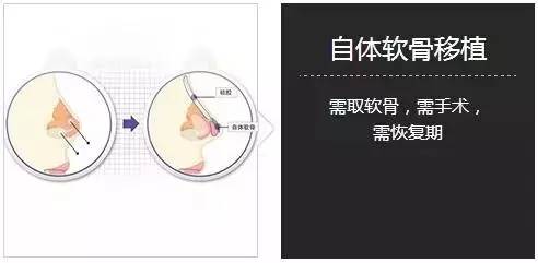 自体软骨隆鼻