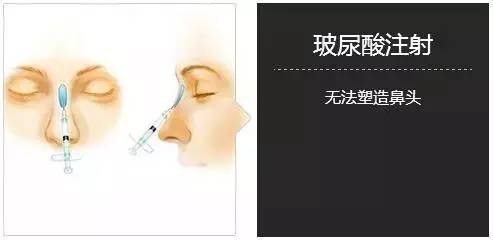 注射隆鼻整形