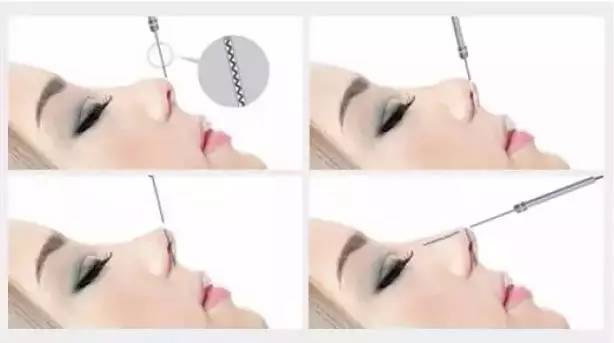 美莱·SMART立体美鼻