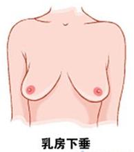上海治疗乳房下垂的价格