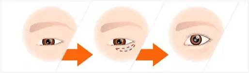 <a href='/' target='_blank'><u>上海美莱</u></a>注射卧蚕