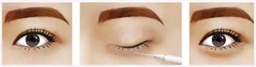 上海美莱自体脂肪填充卧蚕