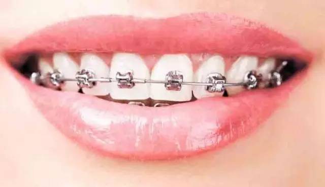 经典MBT直丝弓矫正