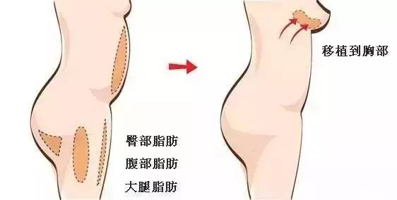 自体脂肪隆胸过程