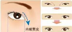 上海美莱开眼角手术