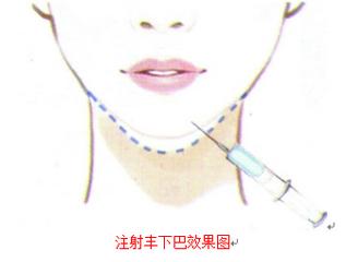 打玻尿酸隆下巴多少钱