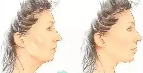 蛋白线面部提升的适应症