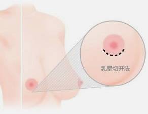 微创丰胸:乳房的隐形微创