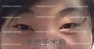 双眼不对称及形态不满意要求修复