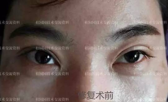 双眼重睑不对称