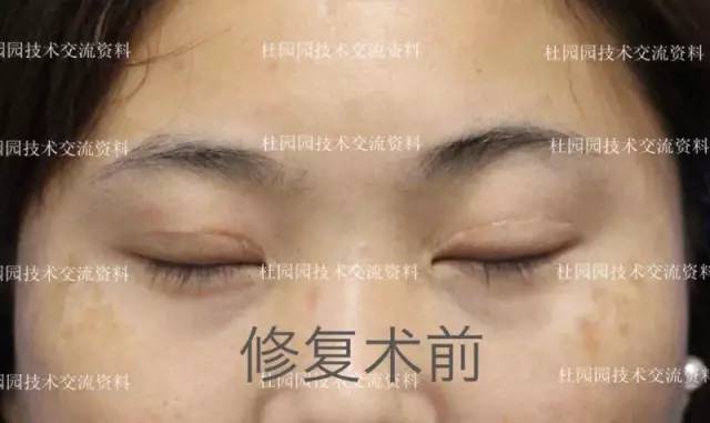 眼部修复术前修复