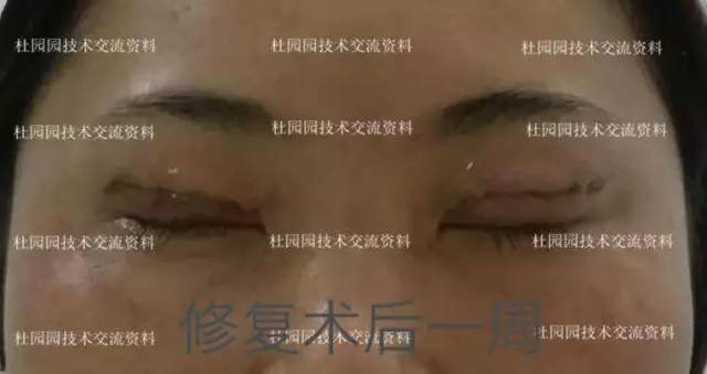 眼修复术后一周