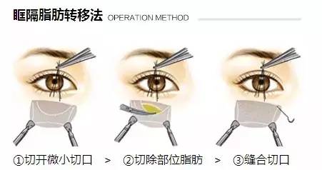 眶隔脂肪转移法祛眼袋