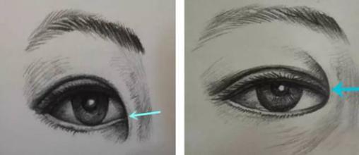 上海美莱开眼角整形手术