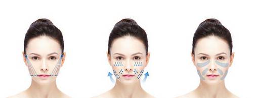 蛋白线面部提升