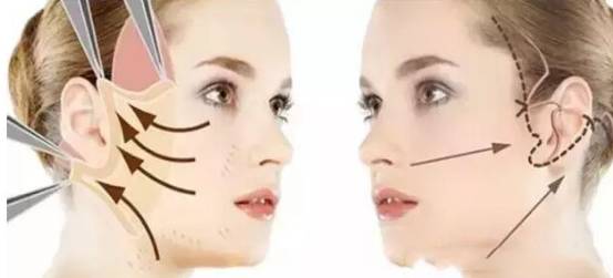 上海美莱蛋白线面部提升功效