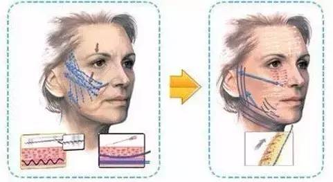 <a href='/' target='_blank'><u>上海美莱</u></a>线雕