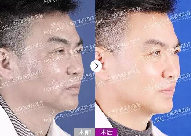 上海美莱线雕案例