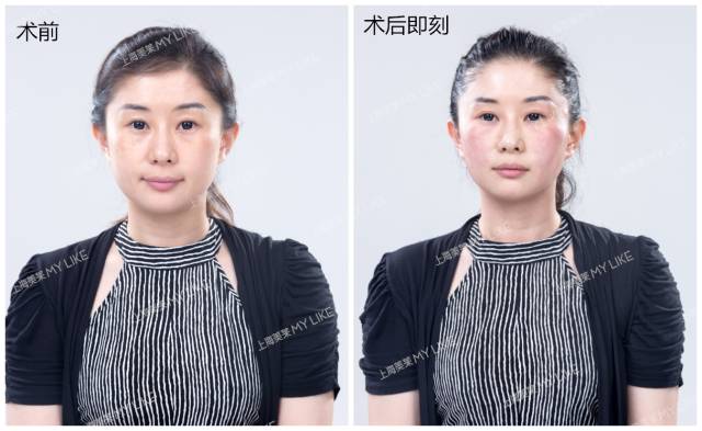 上海美莱真人案例