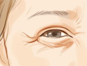 激光除皱多少钱