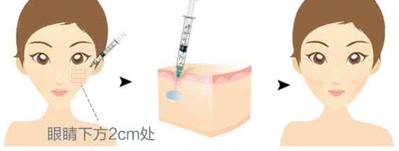 上海美莱丰苹果肌