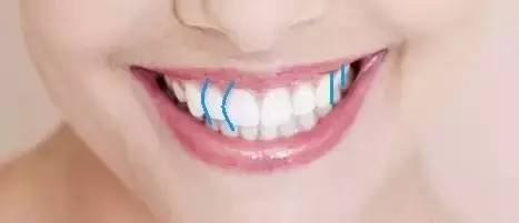 上中切牙远中弧度与侧切牙协调且廓影其近中
